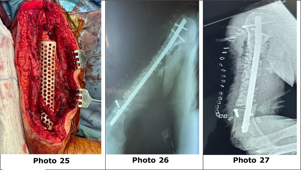 Photo 25. General appearance of the surgical wound after BIOS and the use of a PEEK grid.