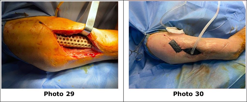 Photos 29, 30 view of the wound after the opening of the seroma of the surgical site, toileting of the wound with dekasan with the installation of inflow VAC to remove remnants of seroma and stimulation of reparative processes in the area of the PEEK grid.