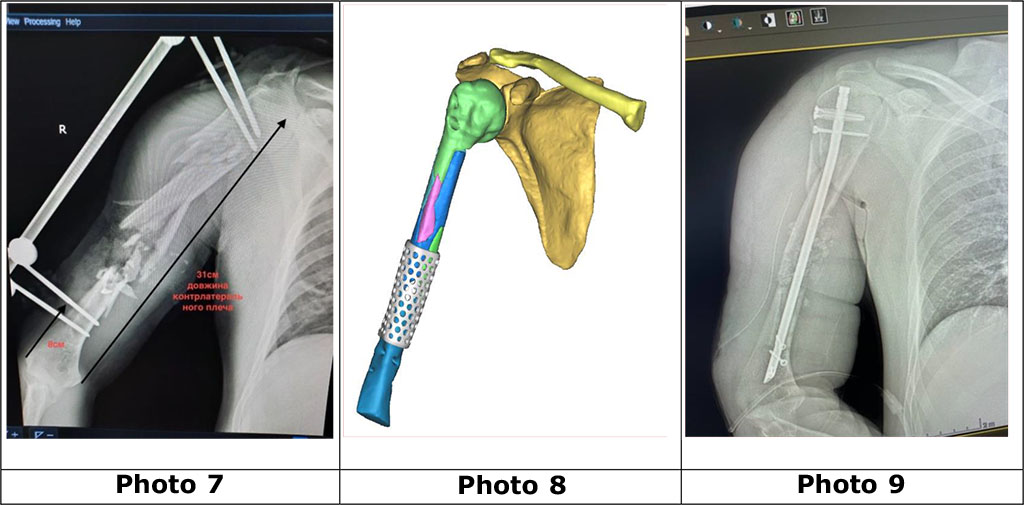 Photo 7. X-ray of the right shoulder with a multifragmentary fracture and a defect of the humerus in the middle third of the diaphysis, which is fixed with a rod device of external fixation.