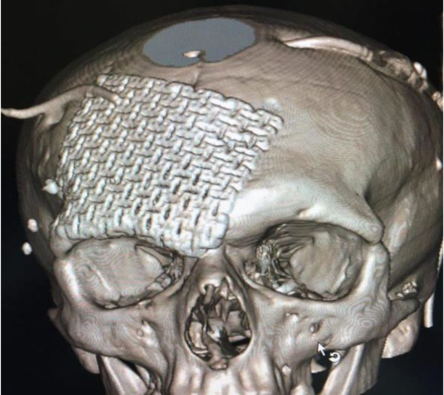 Fig. 2. Photo of a 3D model of a titanium implant (according to the materials of the UNIAN information agency)