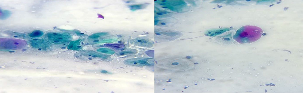 Fig.3. Atypical squamous cells of undetermined significance. Changes suggestive for chronic postradiotherapy period. Papanicolau stain x400