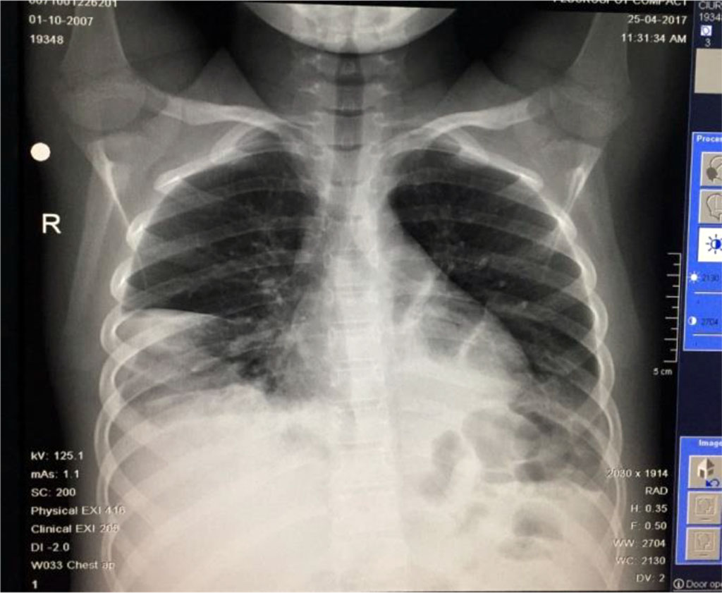 Fig. 11 Medium intensity opacity, inhomogenous, located at the base of right lung and 2 other opacities located retrocardiac