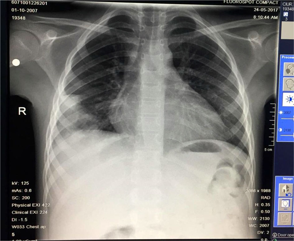 Fig.12 Slow favorable evolution: regression of codensation and the disapearance of the other opacities