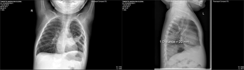 Fig. 2. Transparent lesion of 35/24mm, circled by a 3mm peripheric opaque ring located in the posterior side of left-superior lobe; two air-fluid levels of 8mm and respectively, 40mm located at the posterior basis of left lung