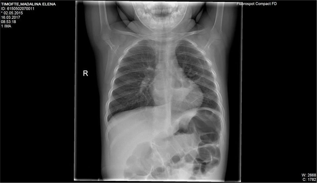 Fig.3 Mild interstital infiltrate of both lungs; pulmonary two radiotransparent lesions that appear near hearth 