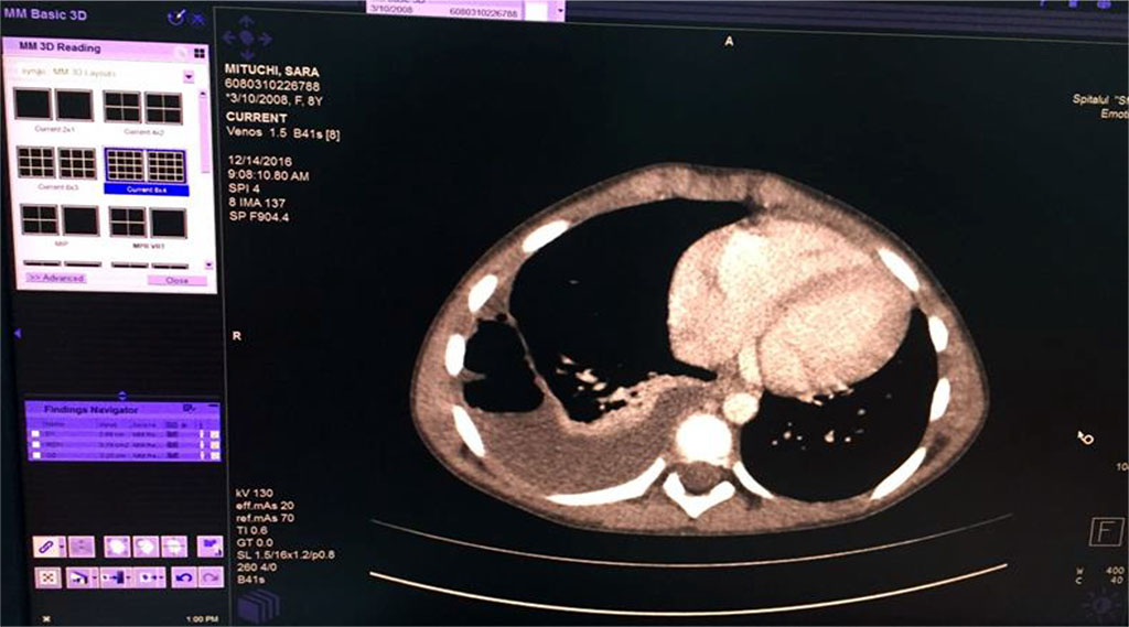 Fig. 5 Right empyema with the thickness of fluid of 27 mm and 22mm thickness of air level
