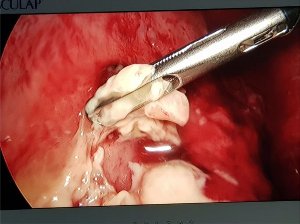 Fig. 9. VAT for pleuropulmonary empyema