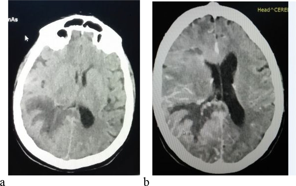 Figure 1 a native computer tomography with digitiform oedema 1b Computer tomography with intravenous contrst substance parietooccipital right infiltrativ process